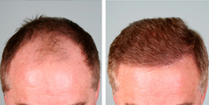 Hair Transplant